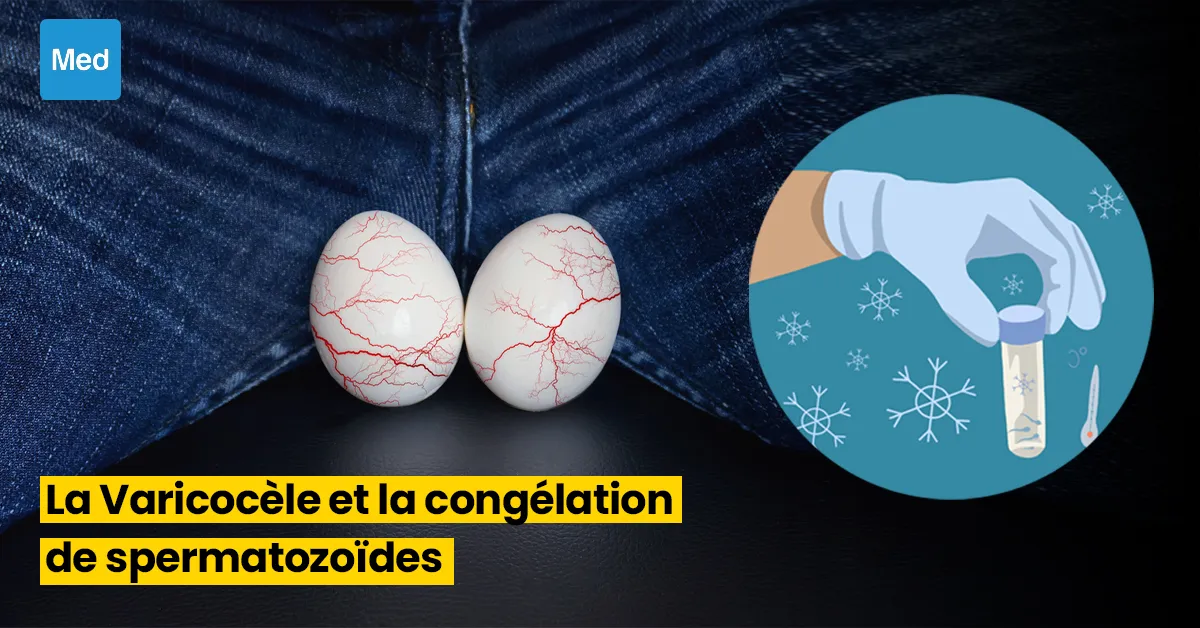 La Varicocèle et la Congélation de Spermatozoïdes : Préservation de la Fertilité avant une Intervention